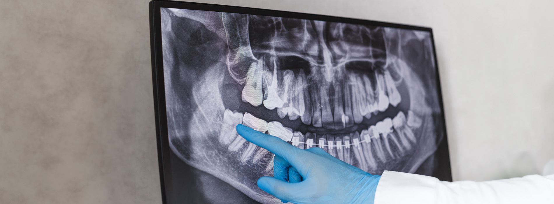 Valley Village Oral Surgery Associates | Wisdom Teeth, Oral Conscious Sedation and Implant Dentistry
