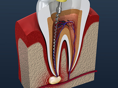 Valley Village Oral Surgery Associates | Wisdom Teeth, Oral Pathology and General Anesthesia
