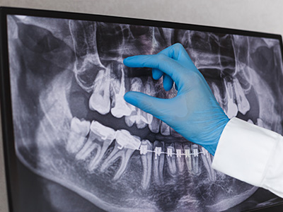 Valley Village Oral Surgery Associates | Oral Conscious Sedation, Wisdom Teeth and Implant Dentistry
