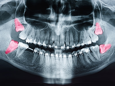 Valley Village Oral Surgery Associates | Wisdom Teeth, Oral Conscious Sedation and Implant Dentistry